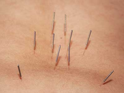 Acupuntura