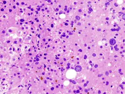 Remédio mais potente contra hepatite C 