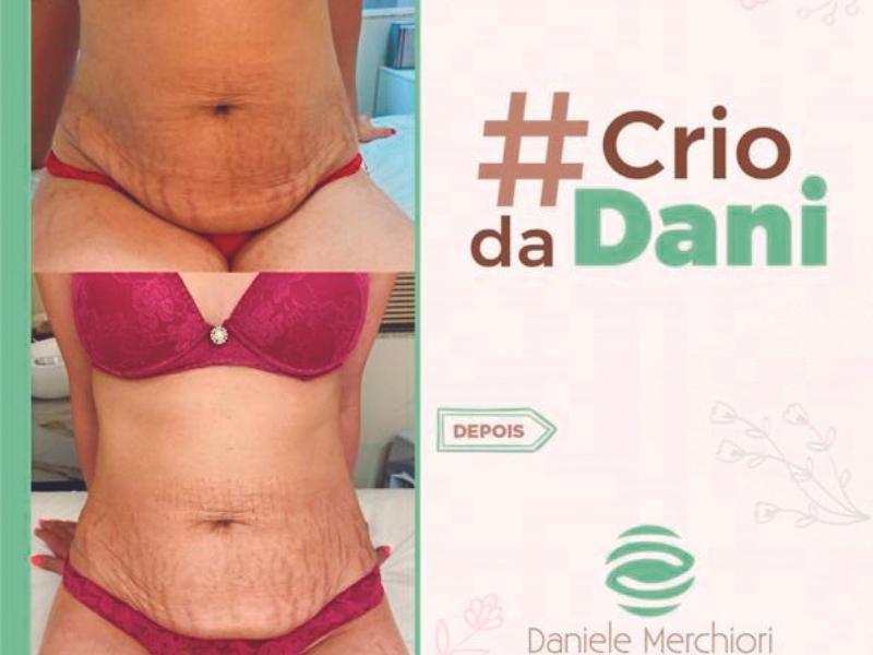 Saiba quais são as diferenças entre Criolipólise convencional e Crio da Dani 